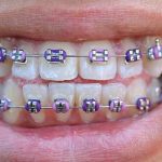 Personalize Your Smile with Pink and Purple Braces